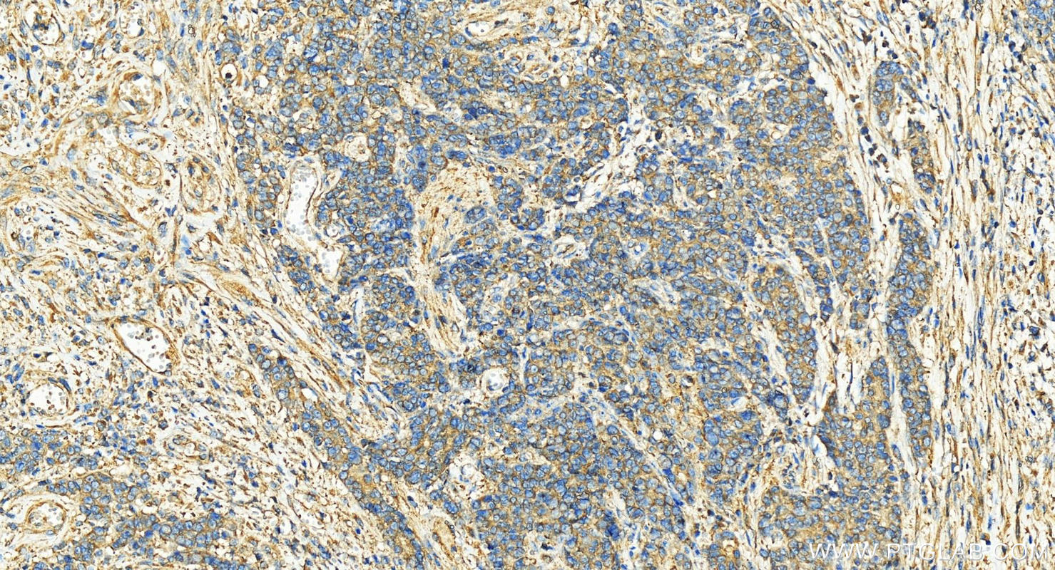 IHC staining of human stomach cancer using 11361-1-AP