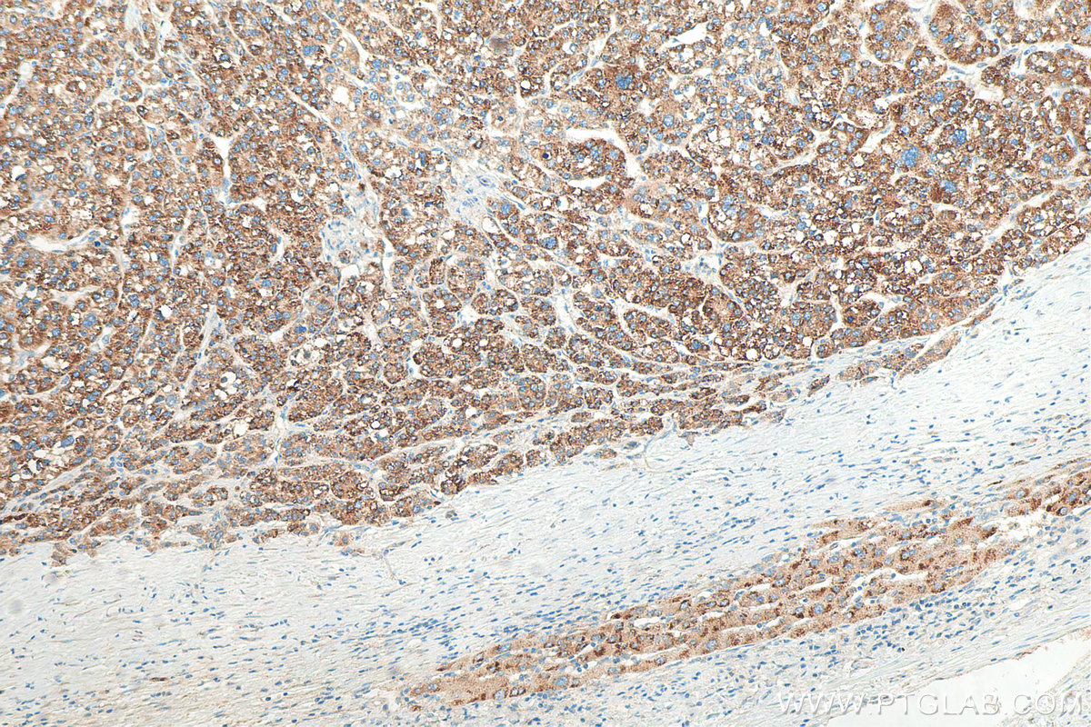 IHC staining of human liver cancer using 18052-1-AP