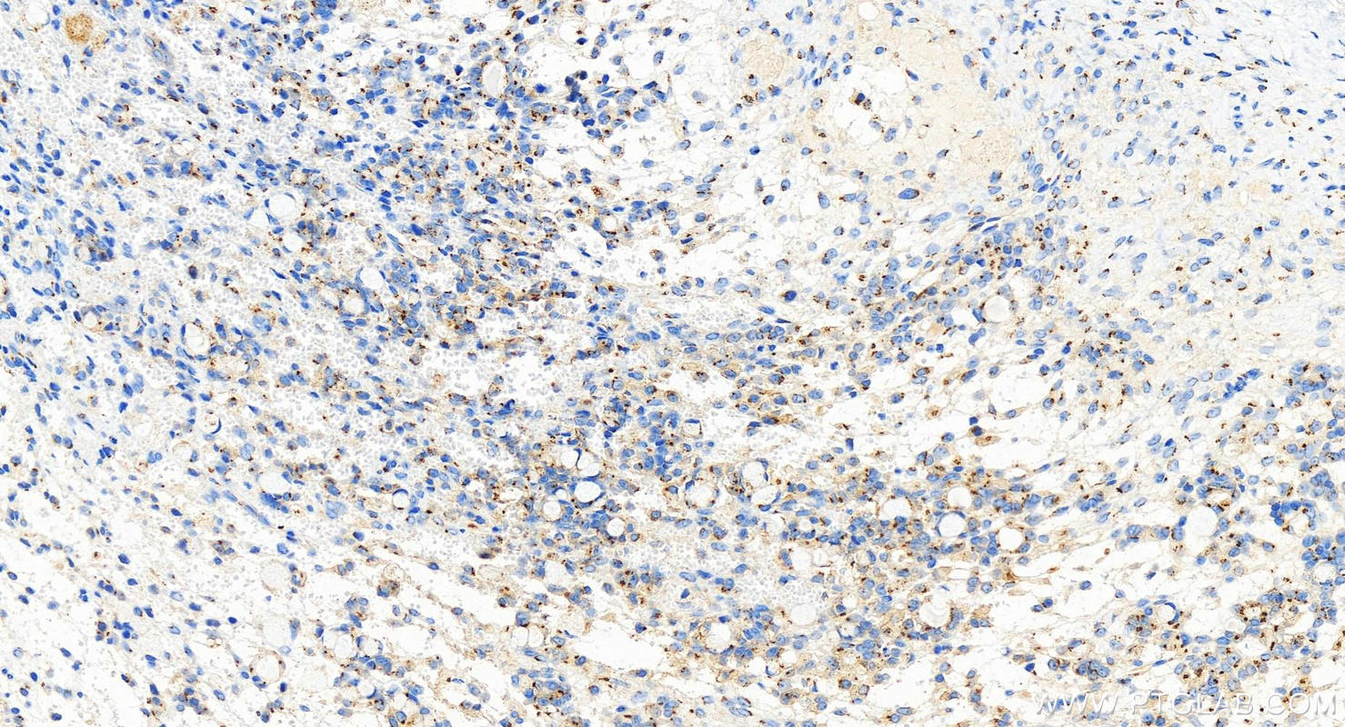 IHC staining of human ovary cancer using 83009-4-RR (same clone as 83009-4-PBS)