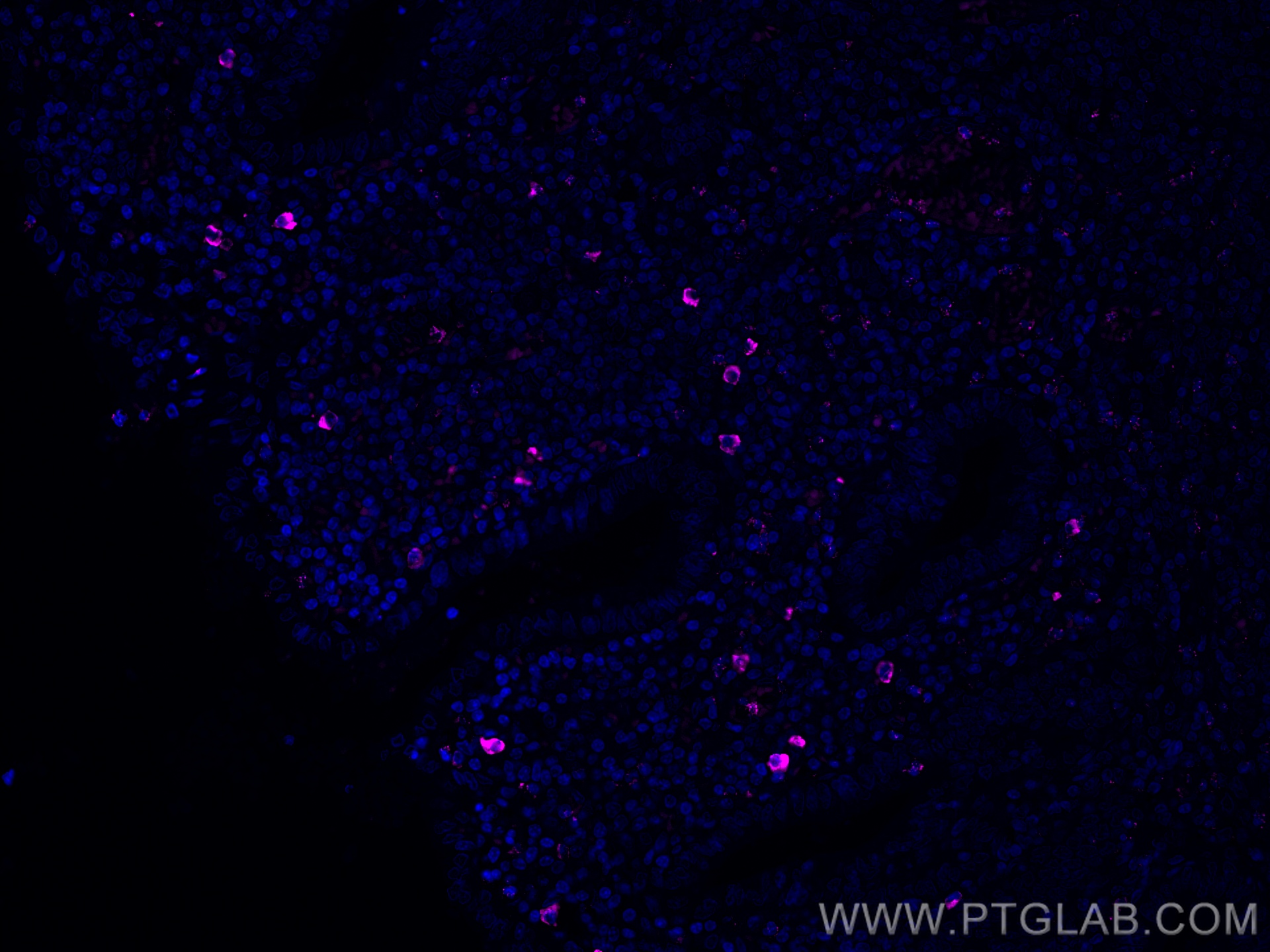 IF Staining of human appendicitis using CL647-66484