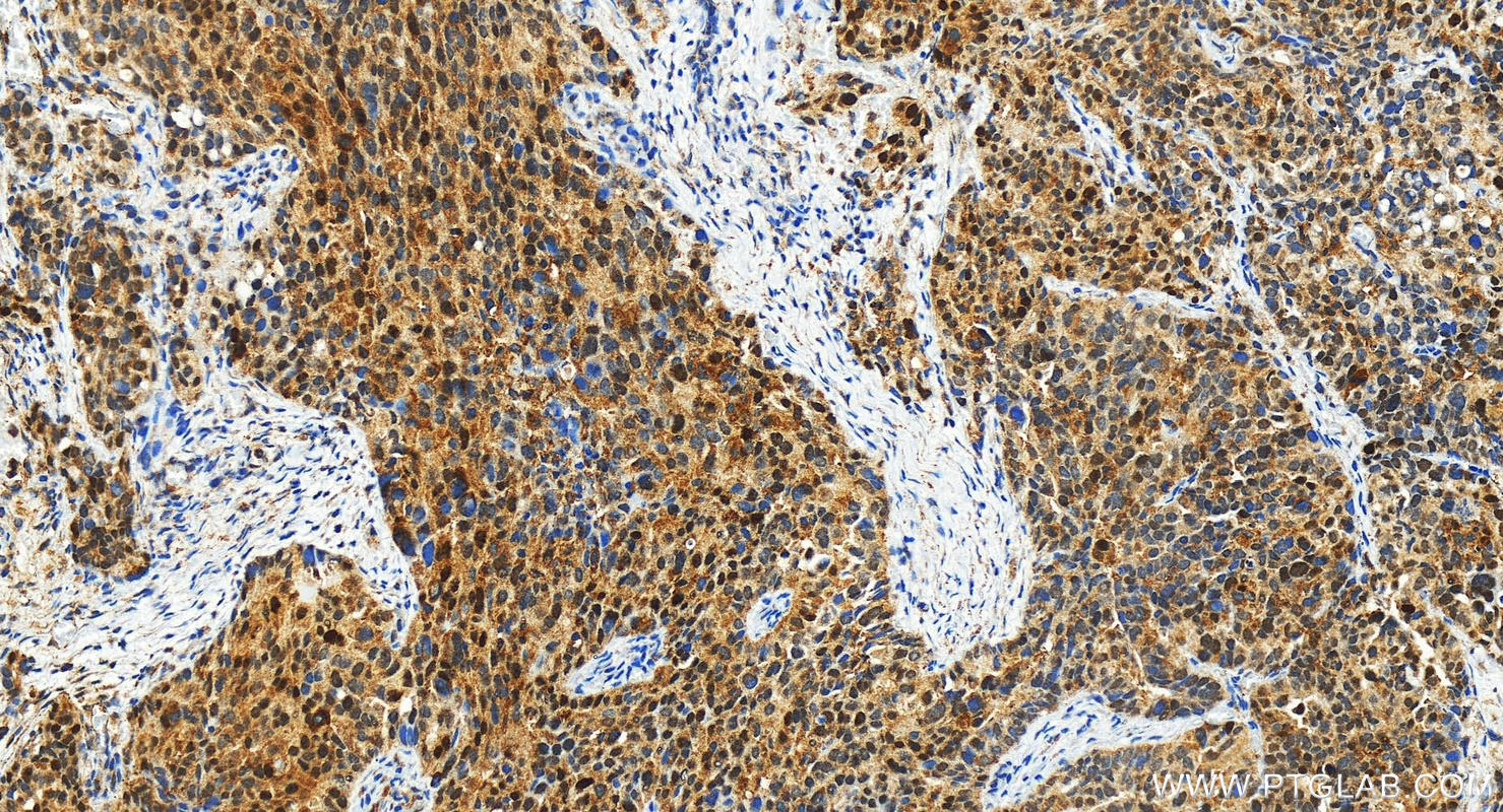 IHC staining of human ovary cancer using 31221-1-AP