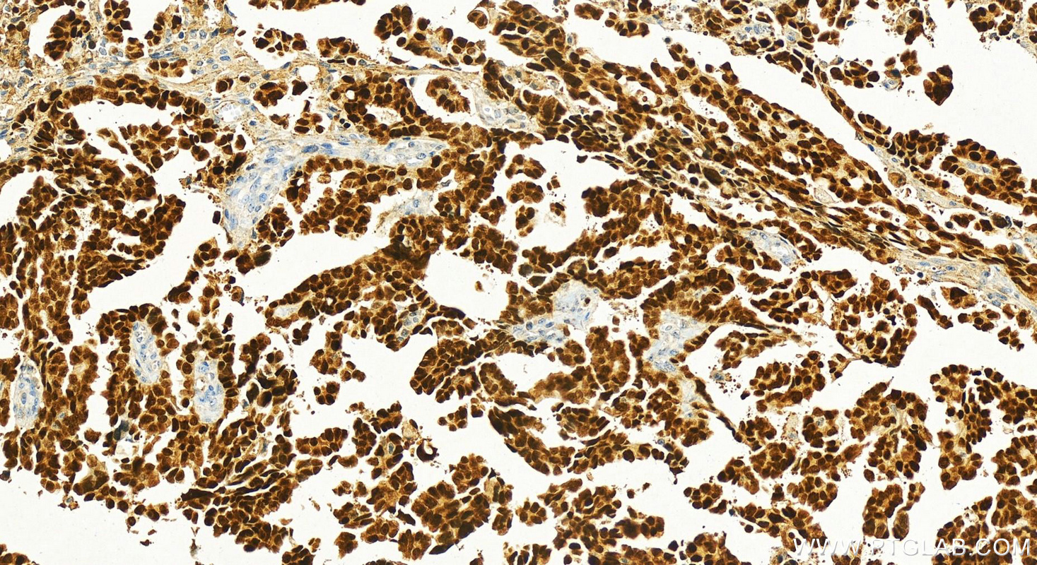 IHC staining of human ovary cancer using 21383-1-AP