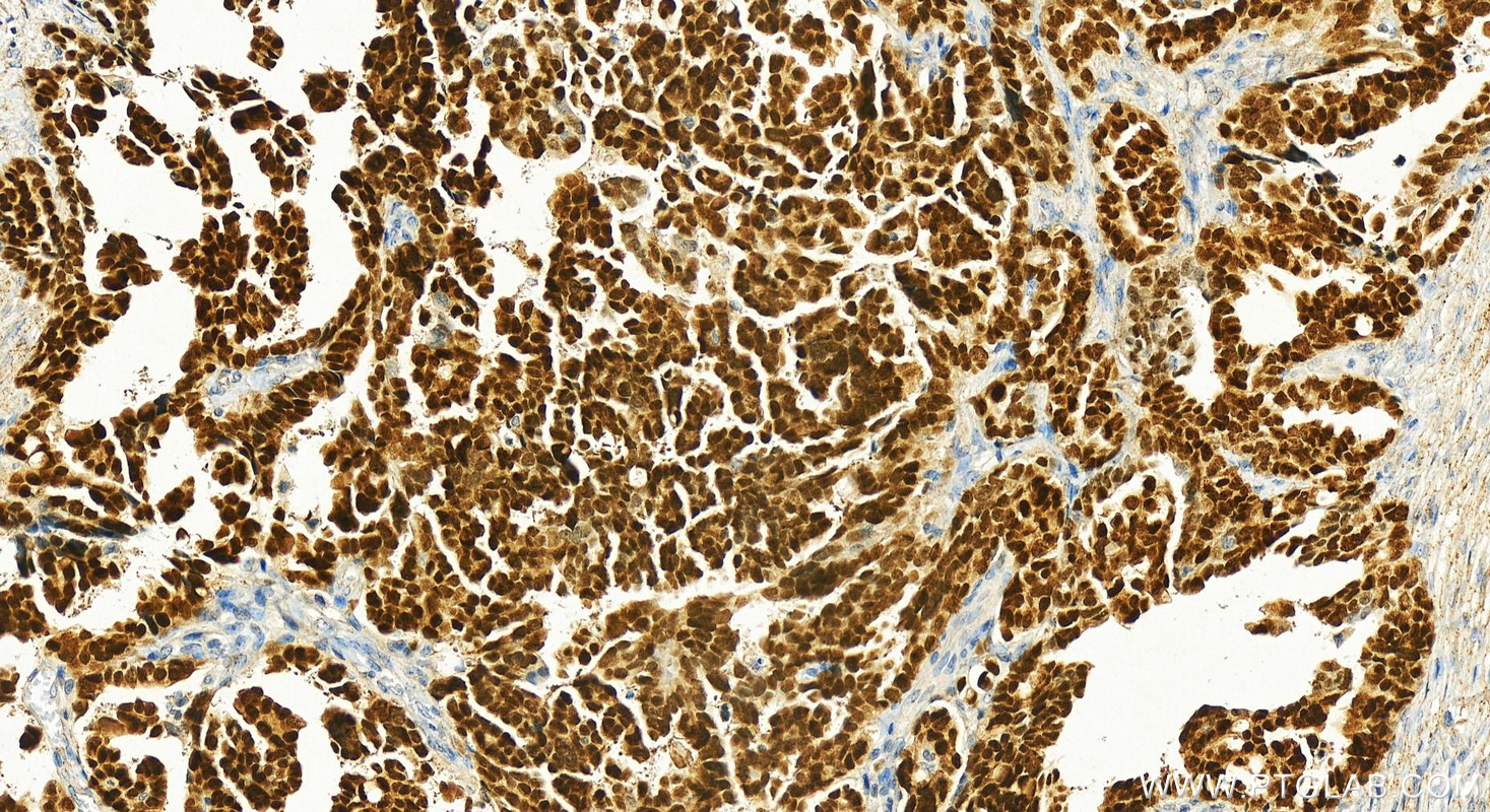 IHC staining of human ovary cancer using 21383-1-AP