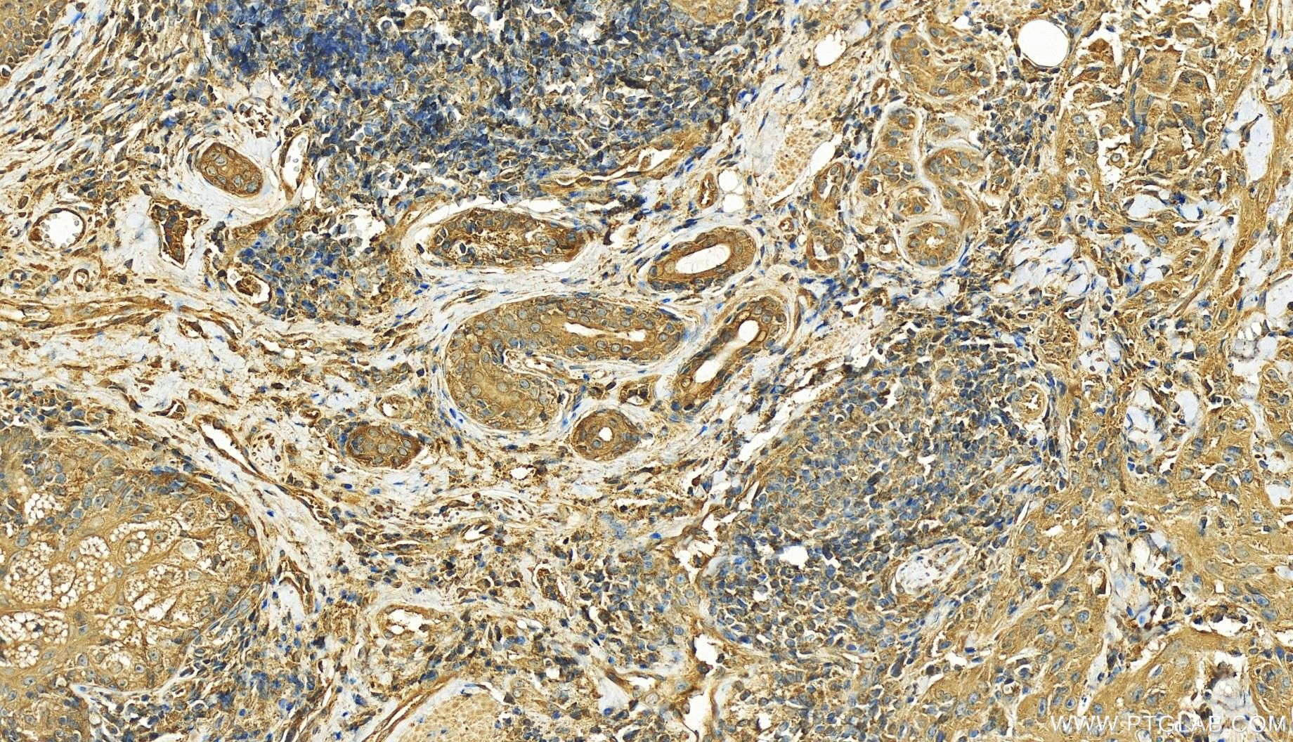 IHC staining of human skin cancer using 26195-1-AP