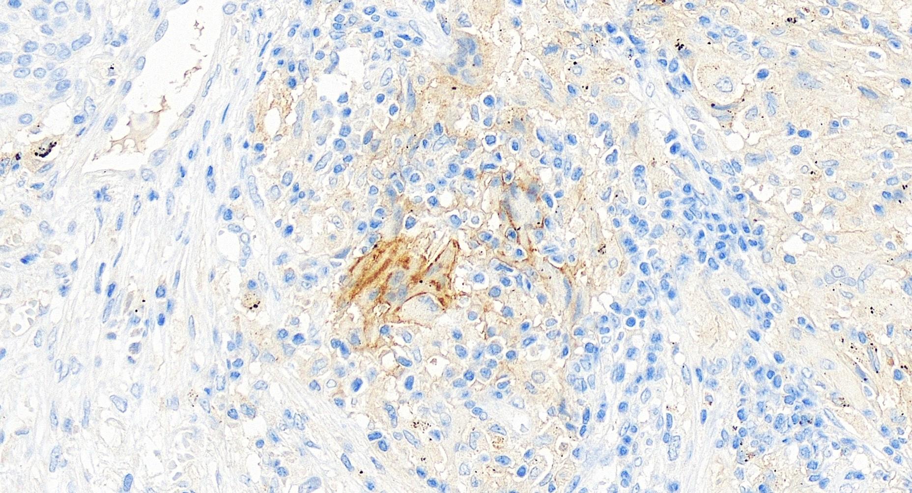 IHC staining of human lung squamous cell cancer using 68727-1-Ig