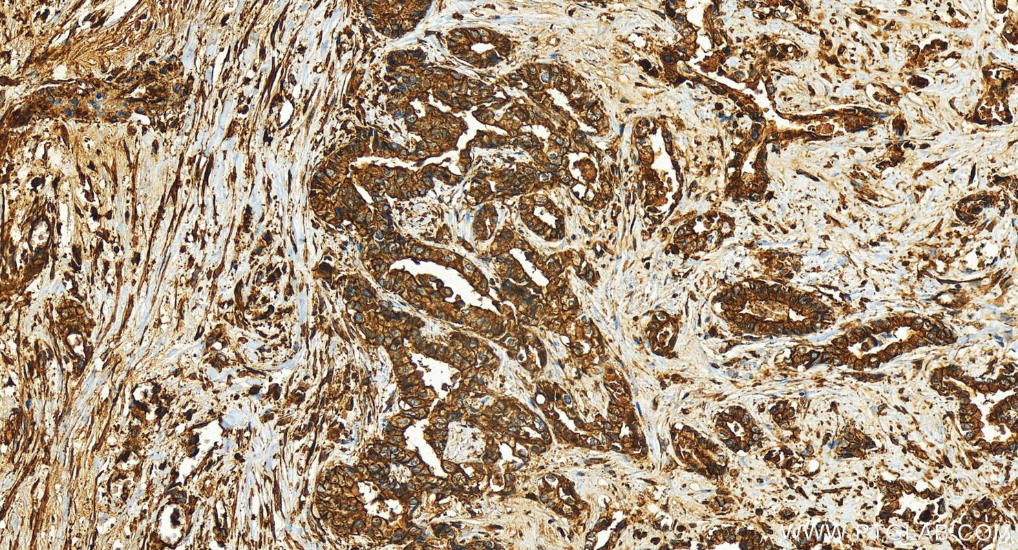 IHC staining of human intrahepatic cholangiocarcinoma using 82953-2-RR (same clone as 82953-2-PBS)