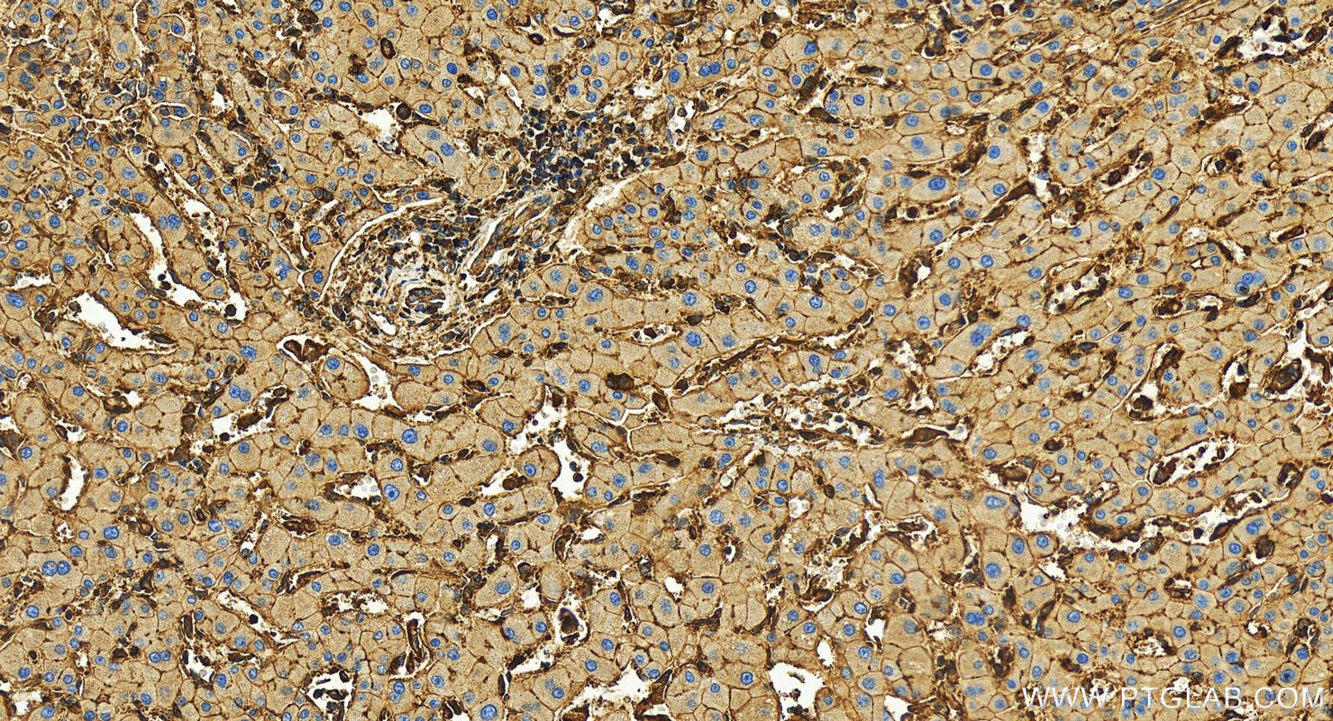 IHC staining of human intrahepatic cholangiocarcinoma using 82953-2-RR (same clone as 82953-2-PBS)