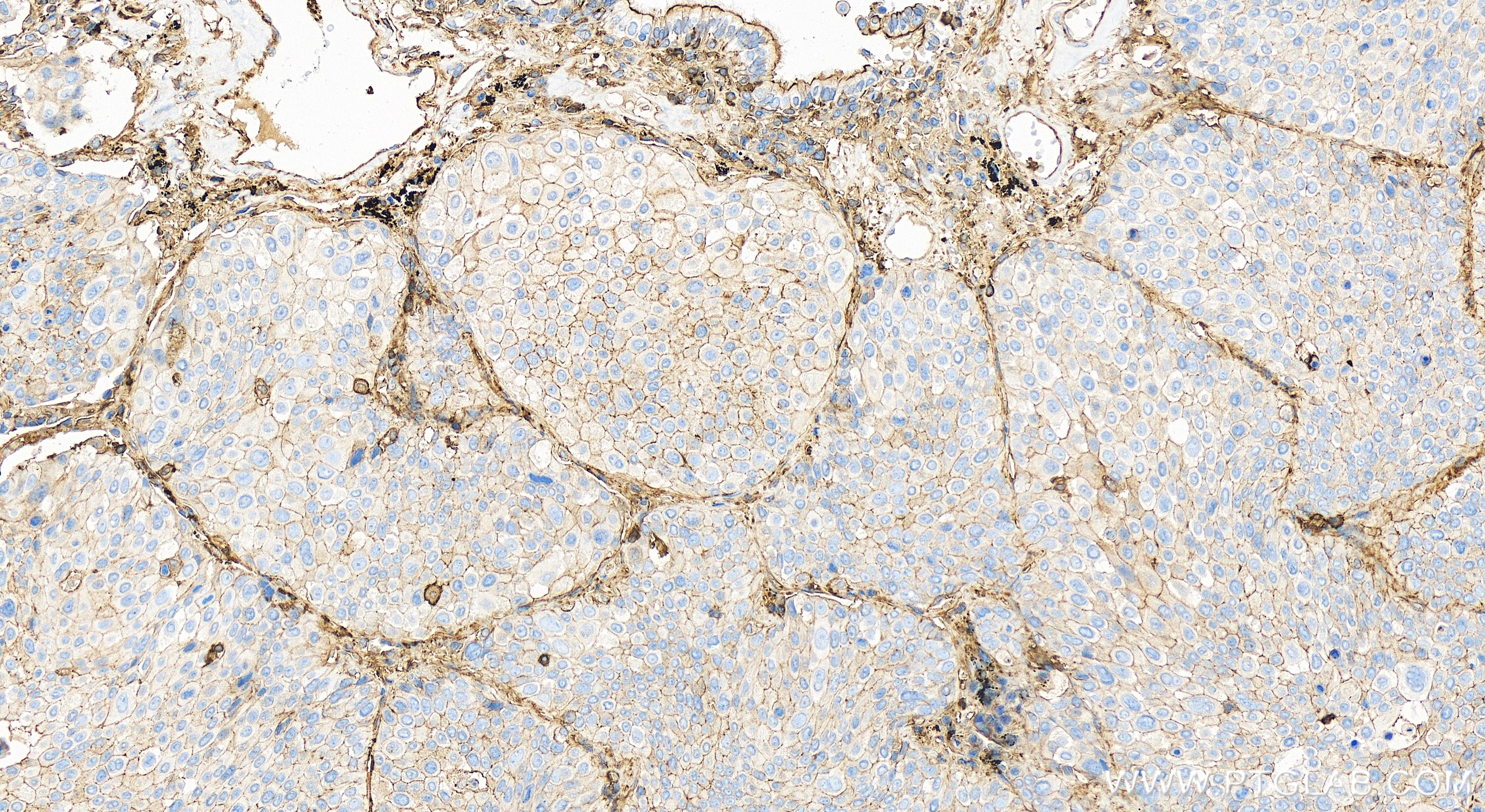 IHC staining of human lung cancer using 82953-2-RR