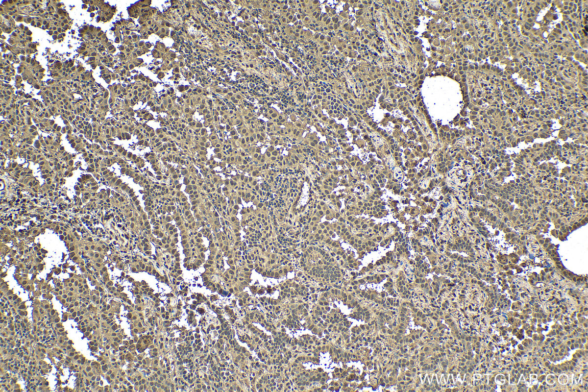 IHC staining of human lung cancer using 80992-1-RR (same clone as 80992-1-PBS)